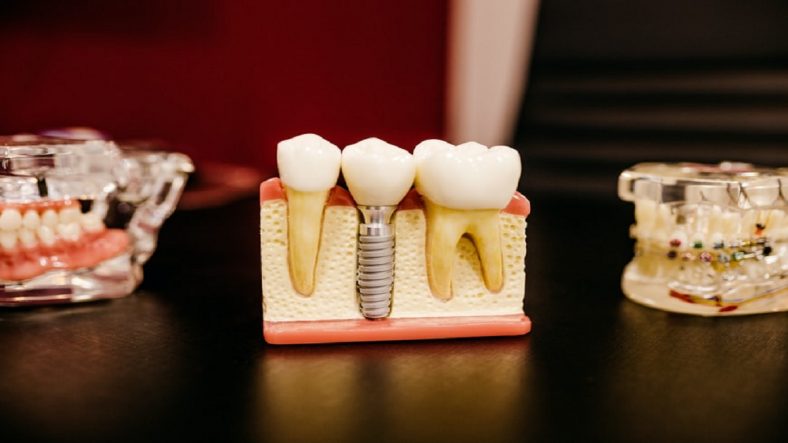 Teeth Whitening Ottawa